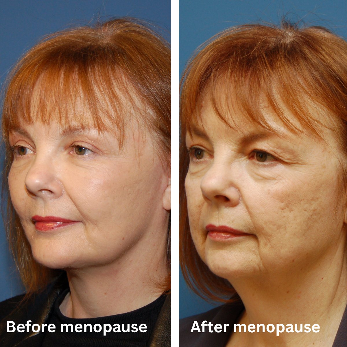 The same woman before menopause and after menopause, showing how quickly skin firmness changes
