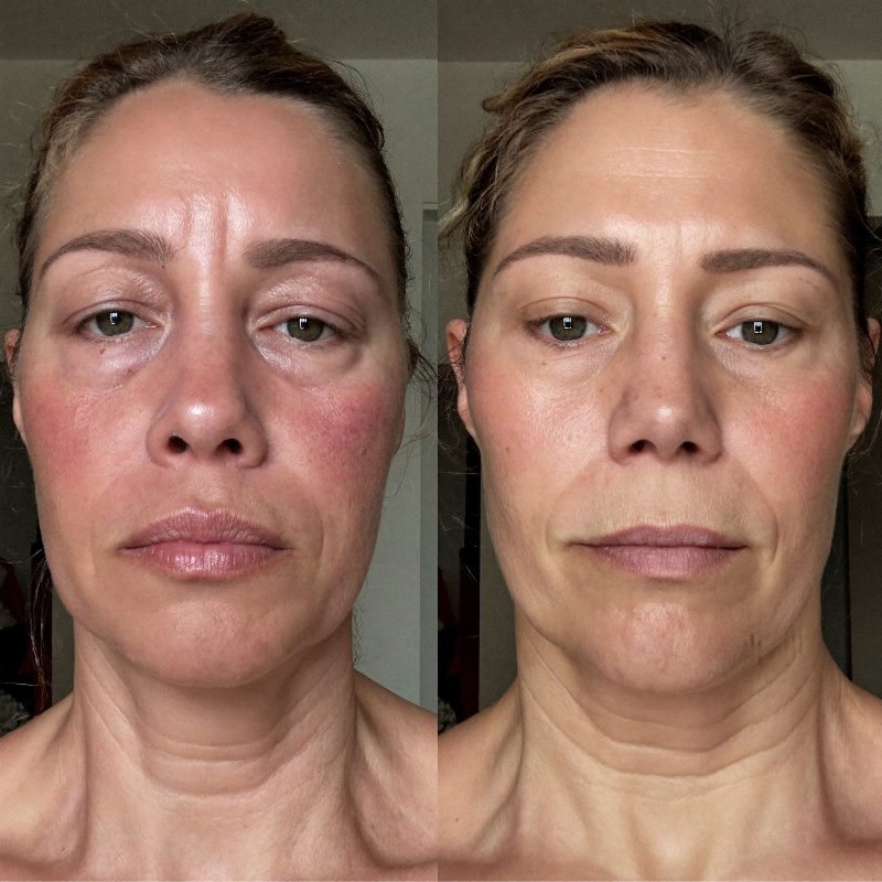 Before and after comparison, woman in her early fifties