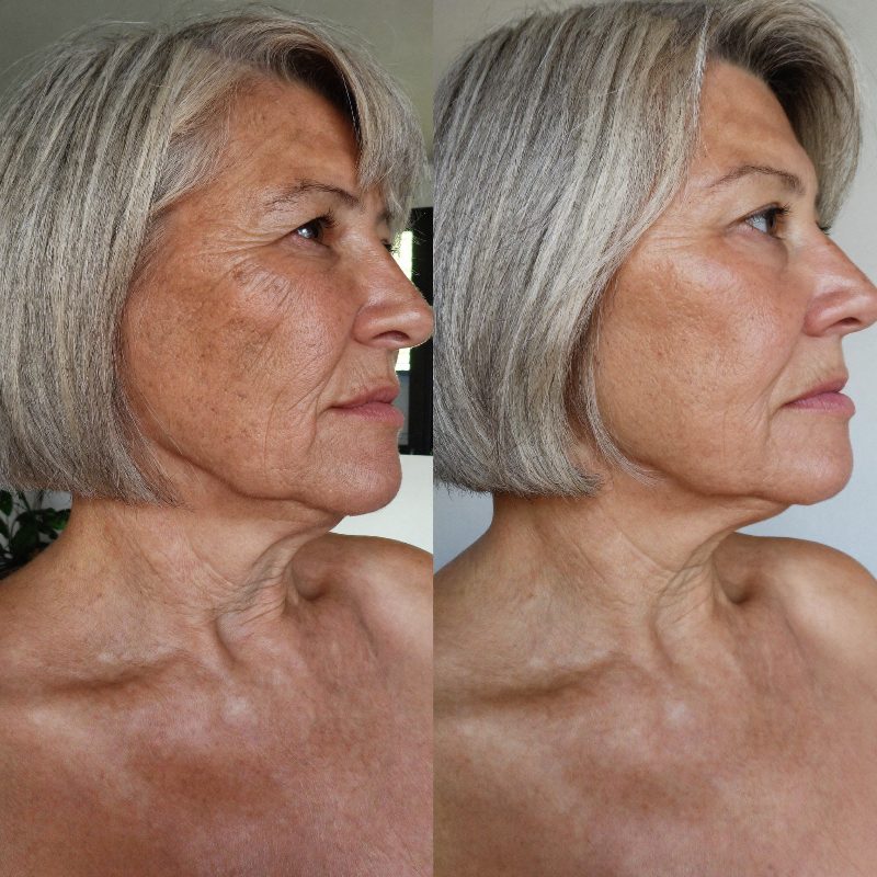 Before and after comparison, jawline and neck