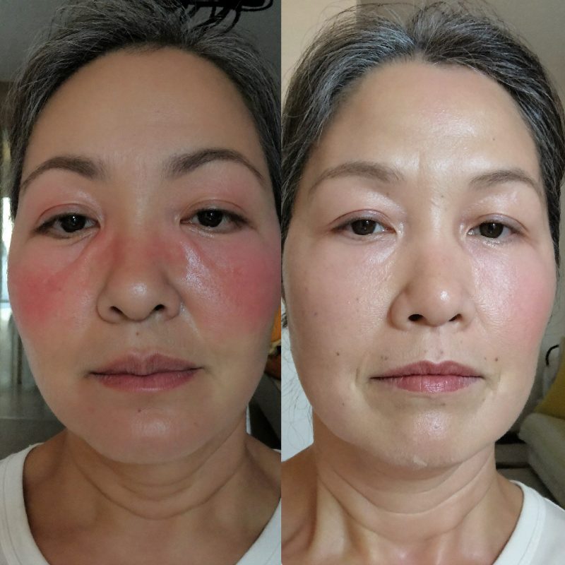 Before and after comparison, woman in her early fifties
