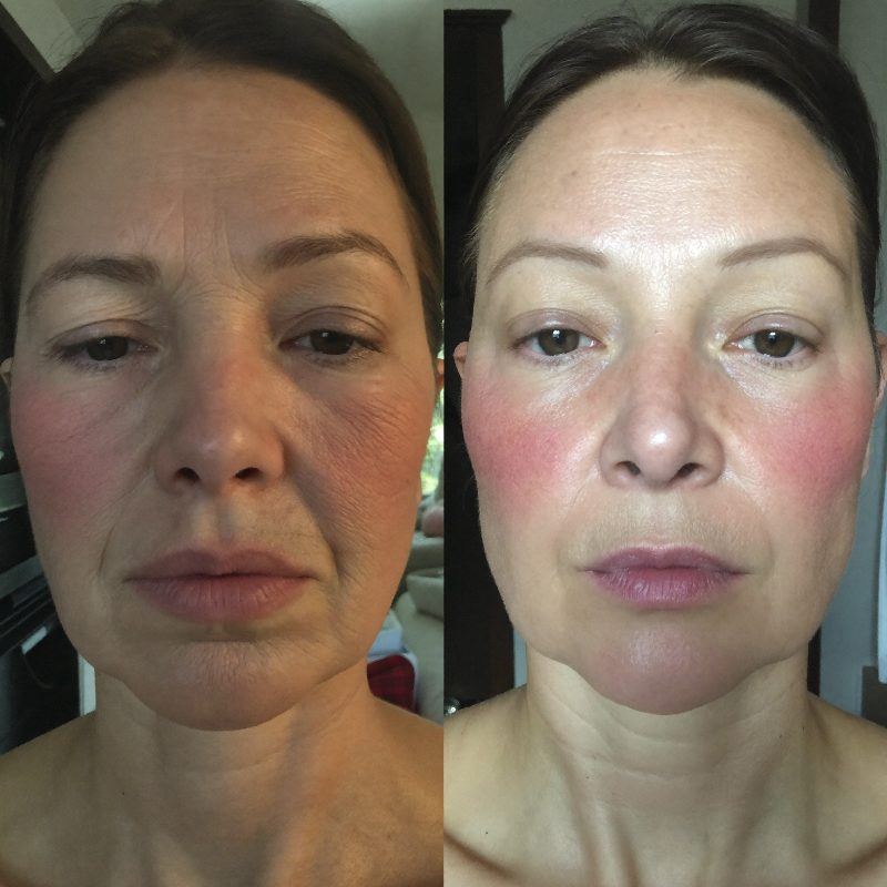 Before and after comparison, woman in her early fifties