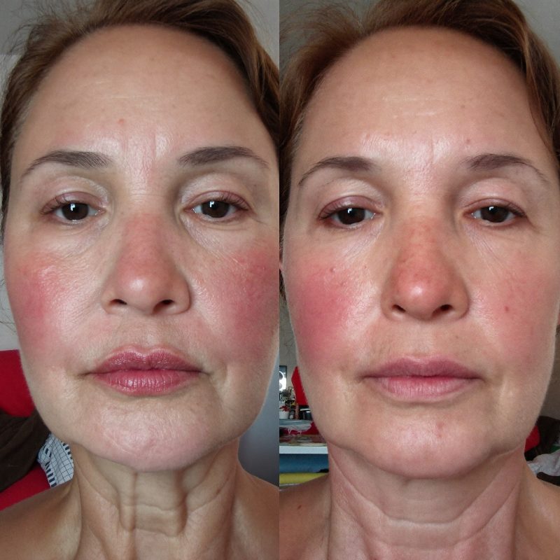Before and after comparison, woman in her early fifties