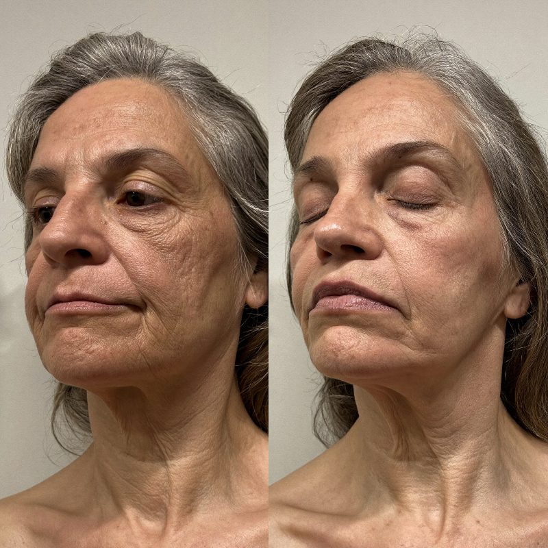 Before and after comparison, woman in her late fifties