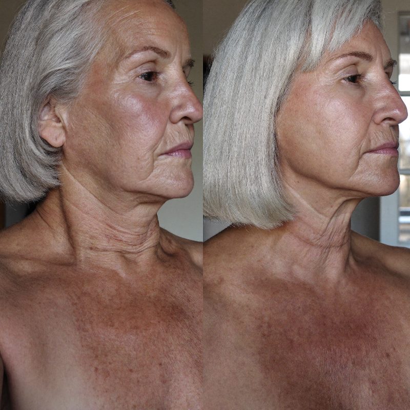 Before and after comparison, jawline and neck
