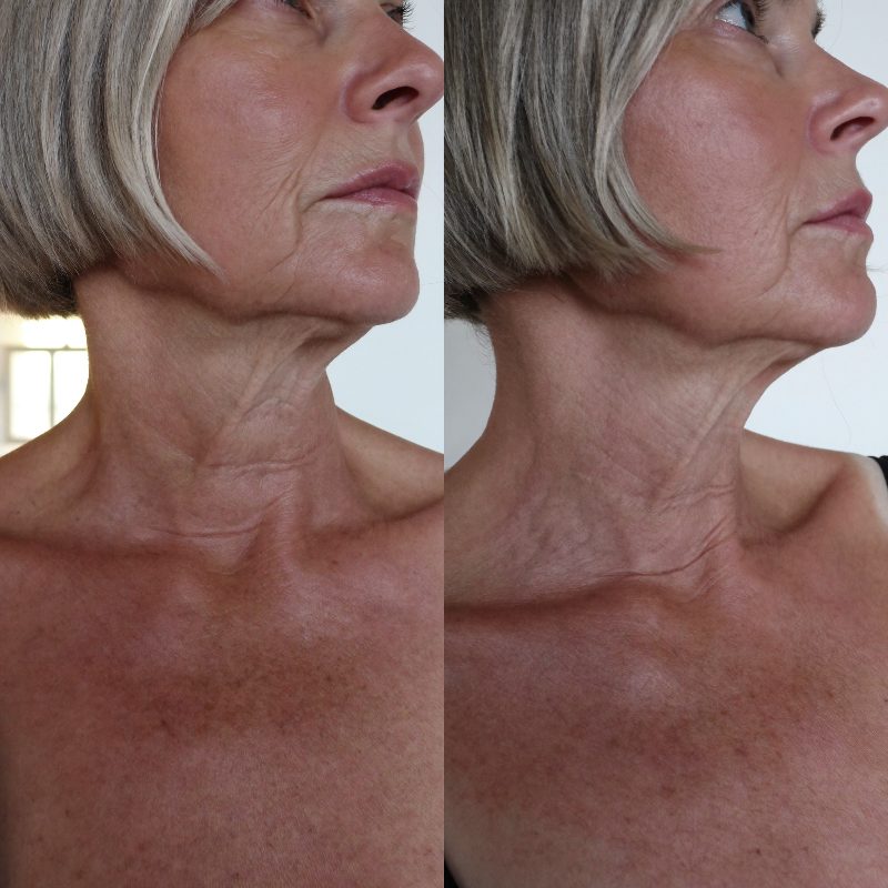 Before and after comparison, jawline and neck